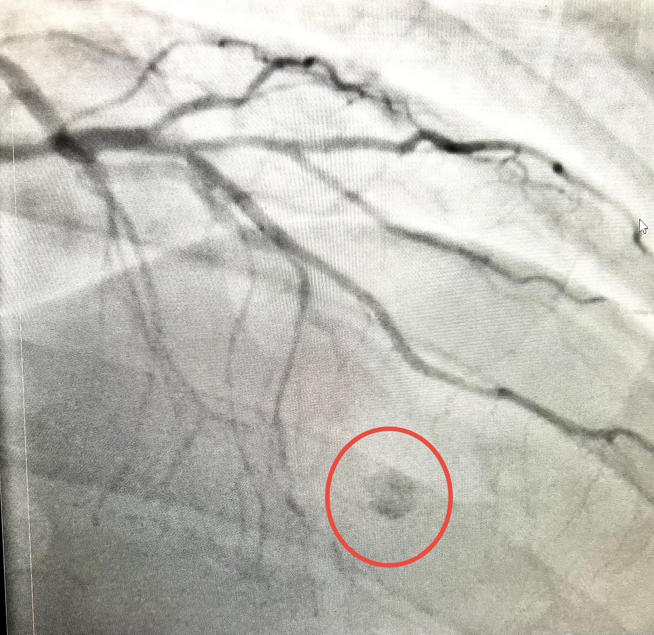 Figure 1. Hemangioma (red circle). Right anterior oblique/cranial view.