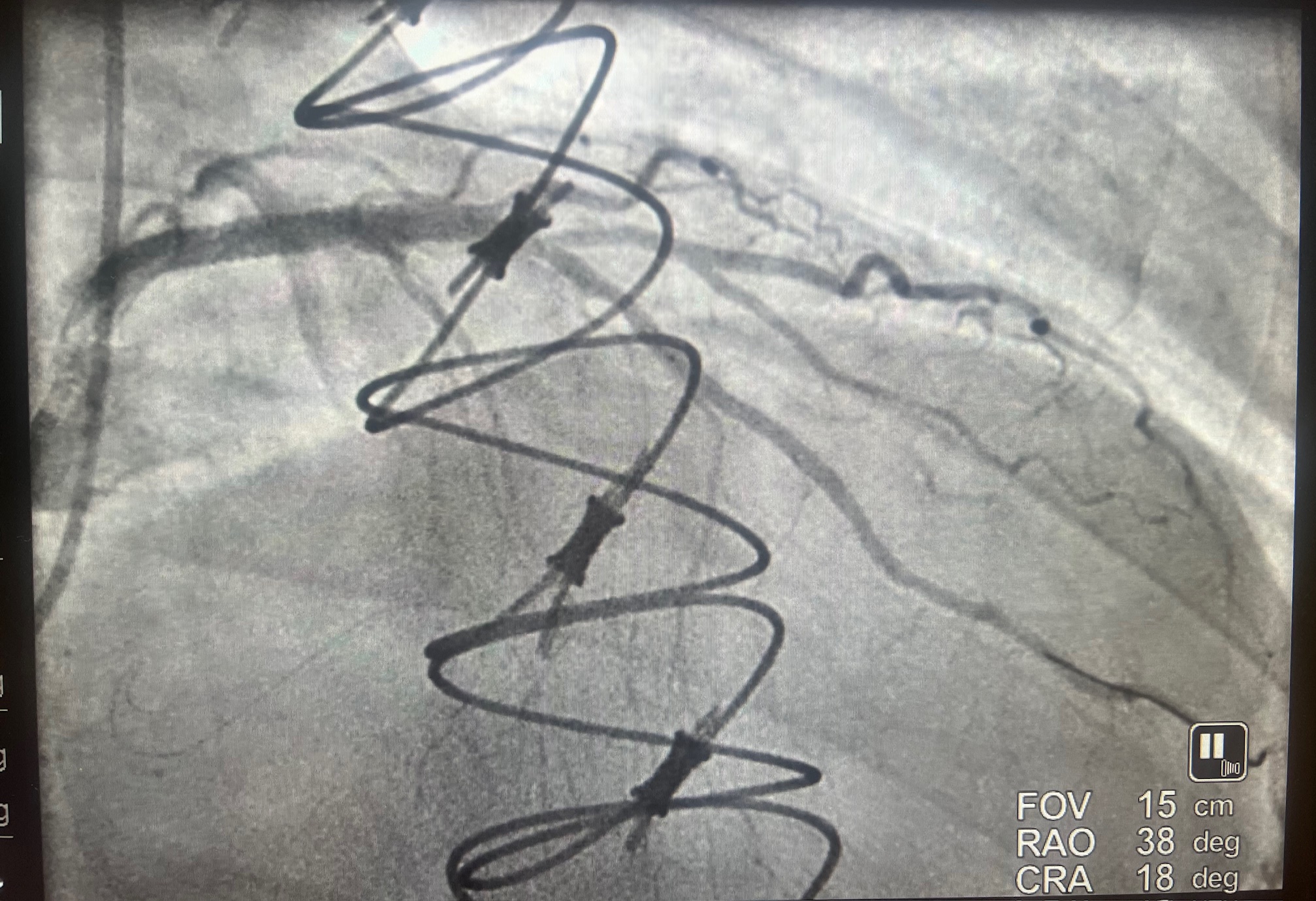 Figure 2. Post removal.