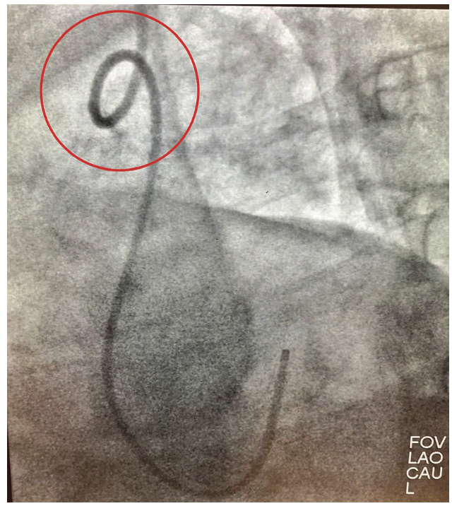 Casazza Kinked Catheter Figure 1