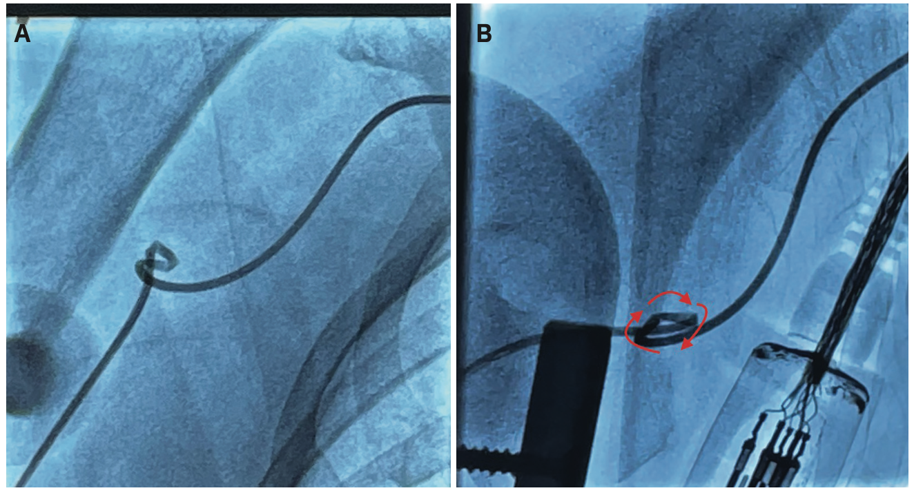 Casazza Kinked Catheter Figure 2