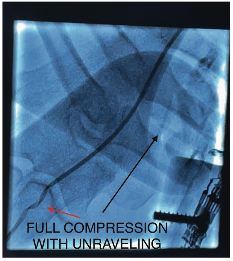 Casazza Kinked Catheter Figure 4