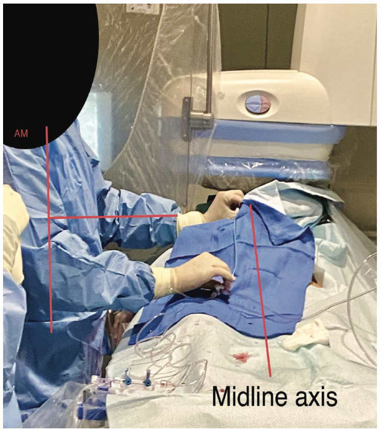 Casazza Left Ulnar Figure 4