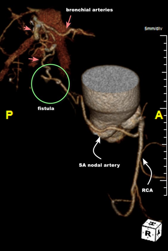 Figure 2. Volume rendered computed-tomography angiography 