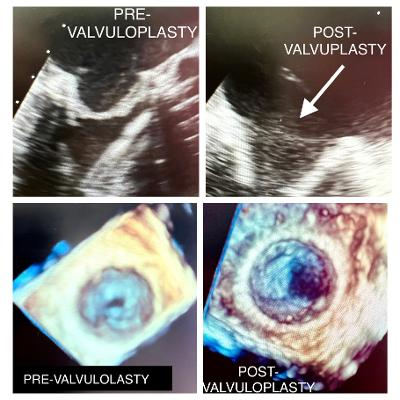 Figure 4. Pre- and post- intraoperative Echo