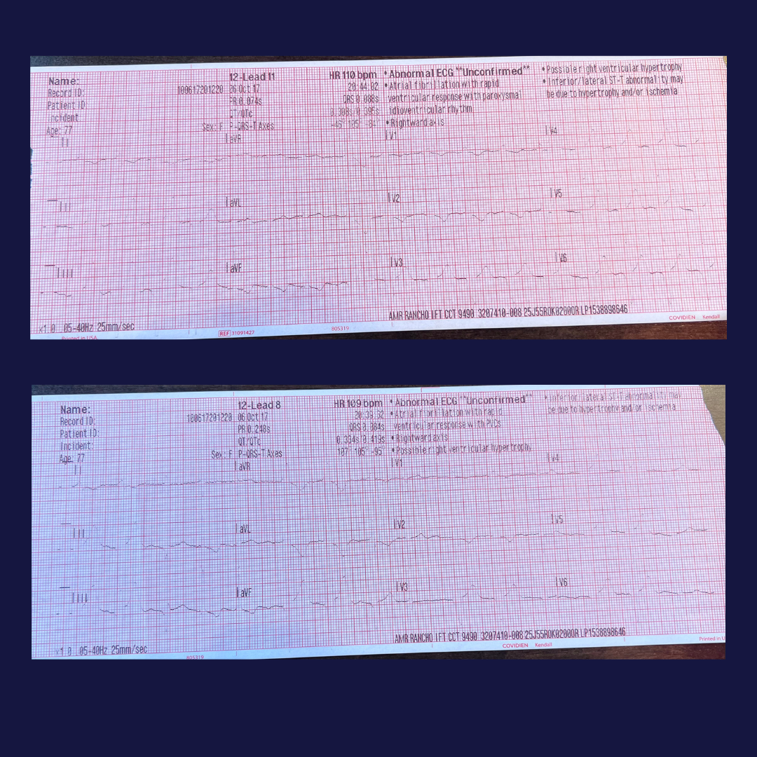 Case 1 EKGs