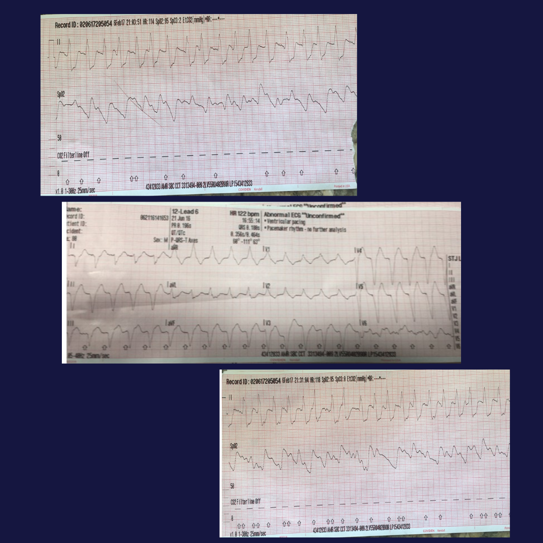 Case 2 EKGs