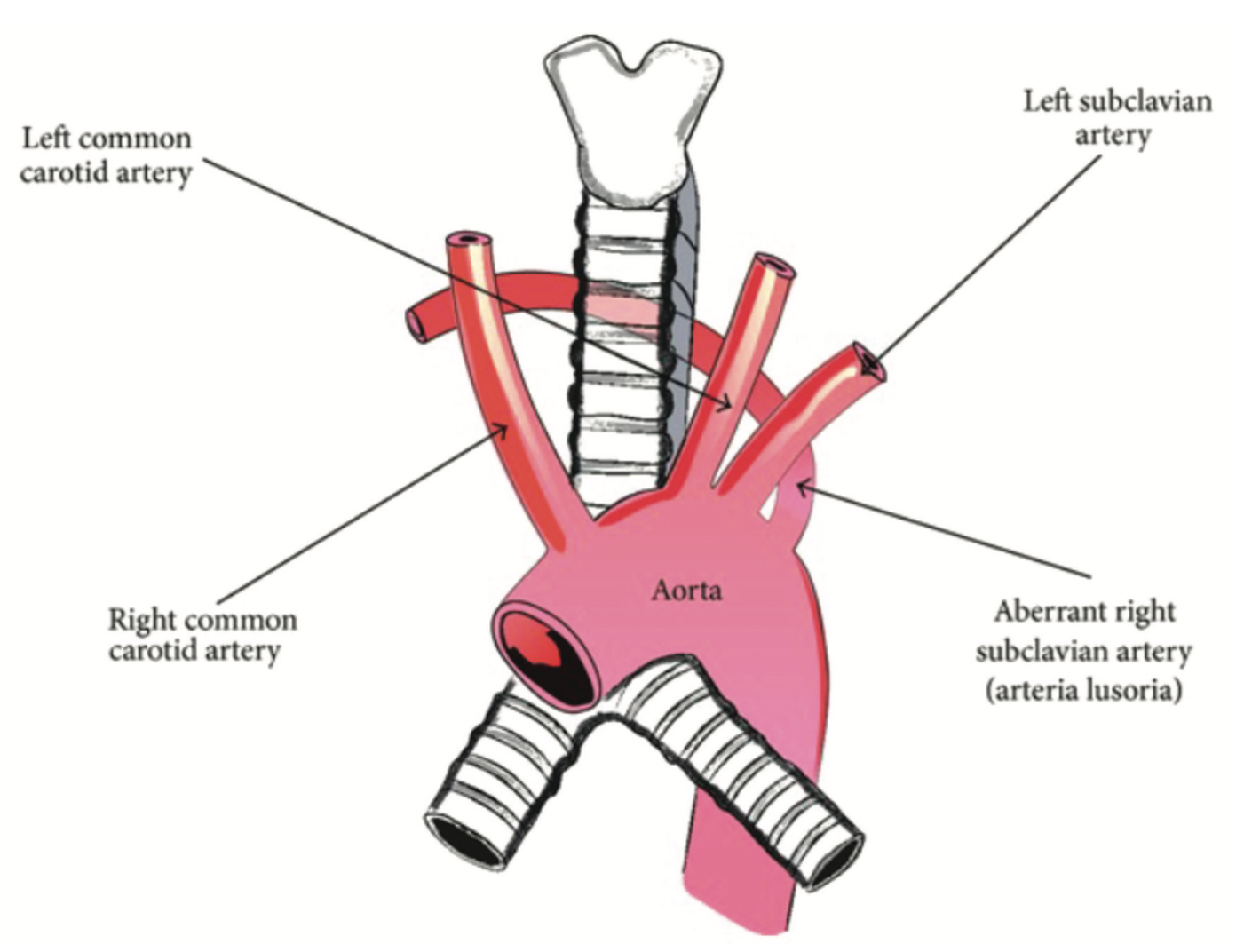 Cassazza Arteria Lusoria Figure 1