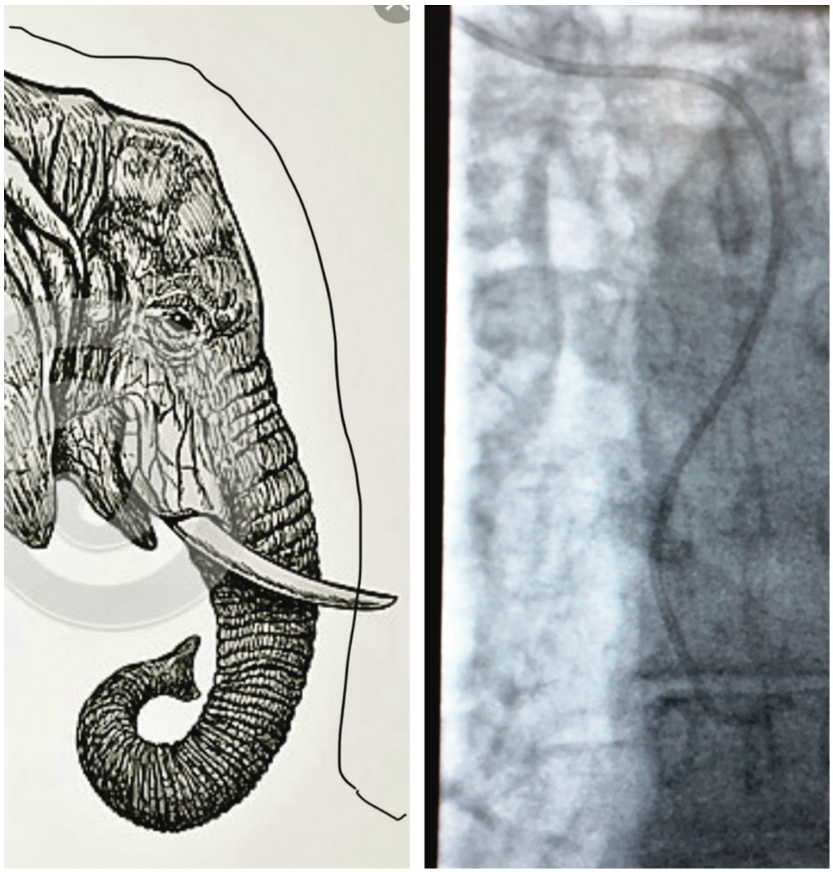 Cassazza Arteria Lusoria Figure 2A
