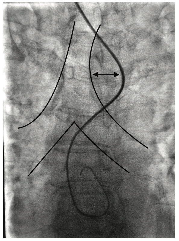 Cassazza Arteria Lusoria Figure 2B