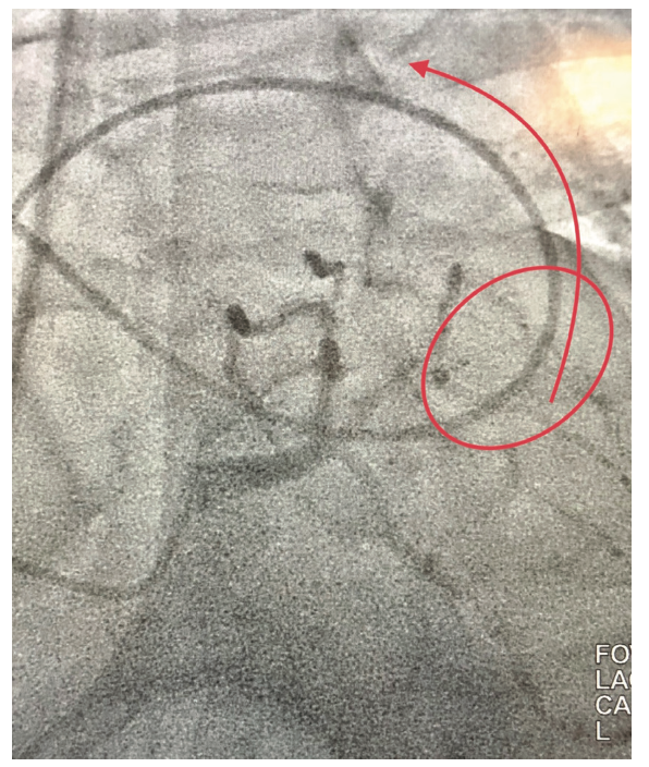 Cassazza Arteria Lusoria Figure 3