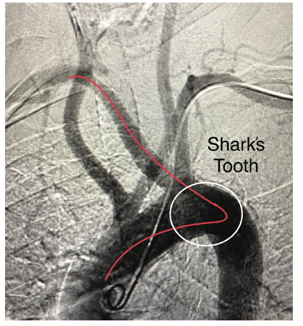 Cassazza Arteria Lusoria Figure 4A