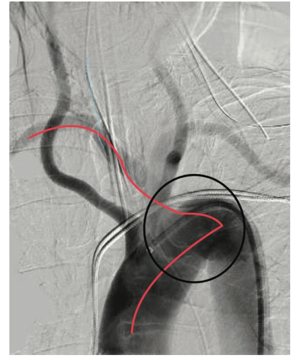 Cassazza Arteria Lusoria Figure 4B