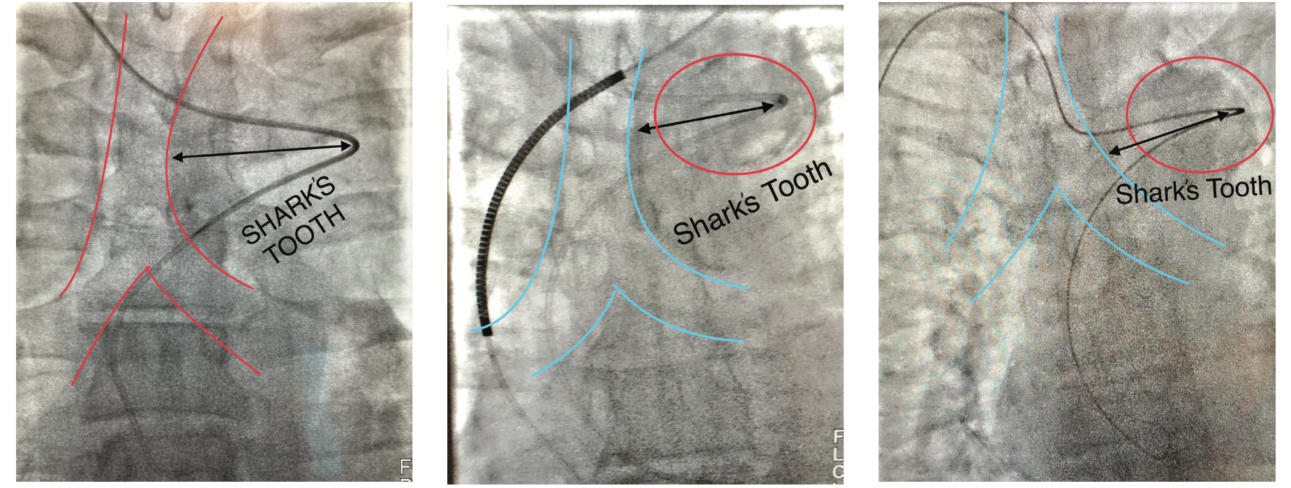 Cassazza Arteria Lusoria Figure 5-7