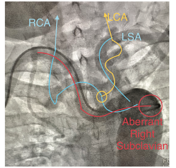 Cassazza Arteria Lusoria Figure 8