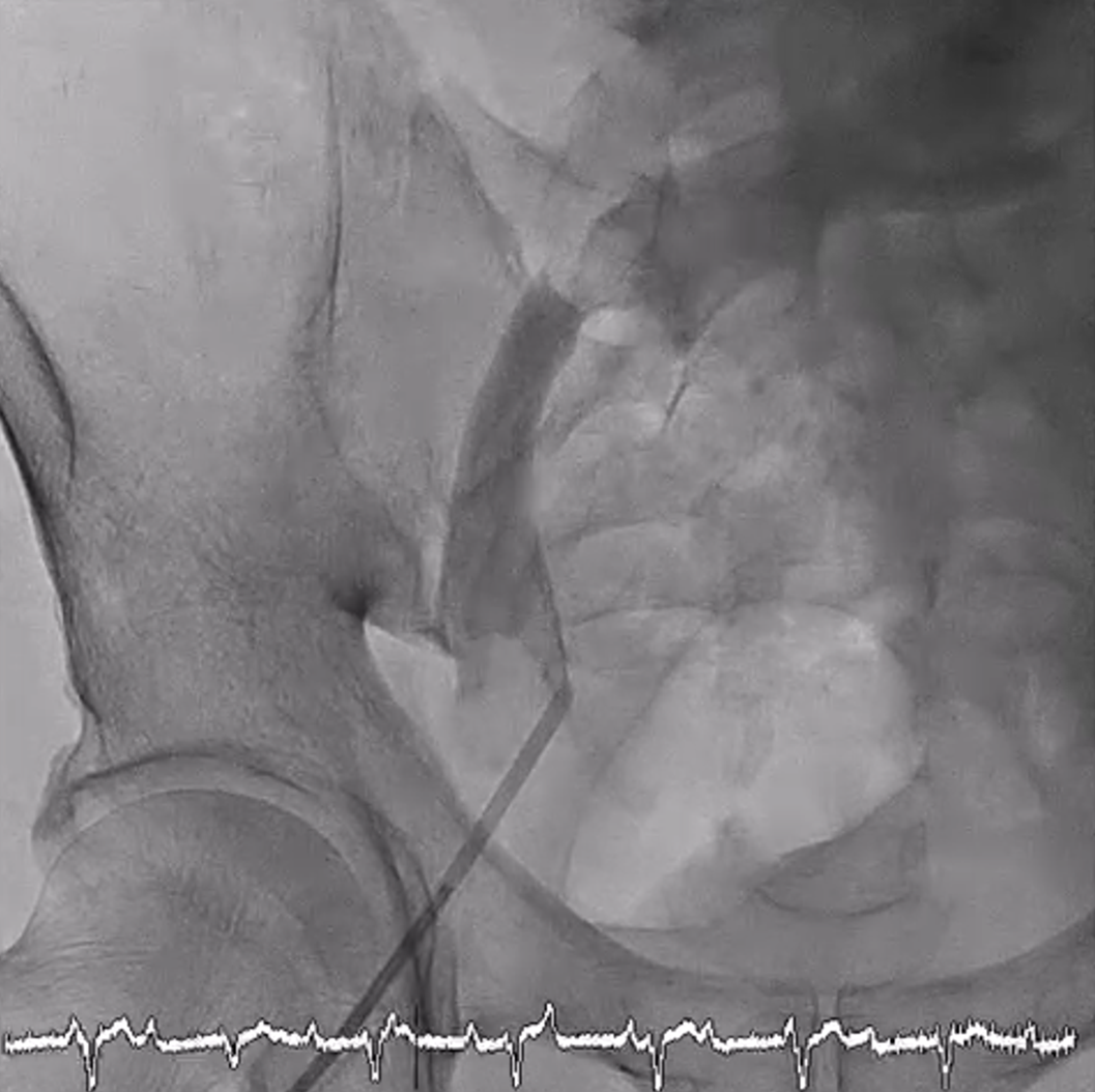 Figure 1. Contrast venogram of the right femoral vein