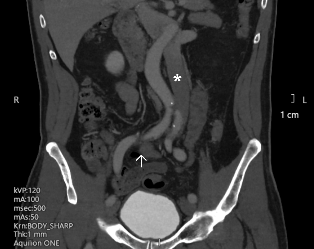 Figure 2B. The right iliac vein appeared to be compressed by the left iliac artery