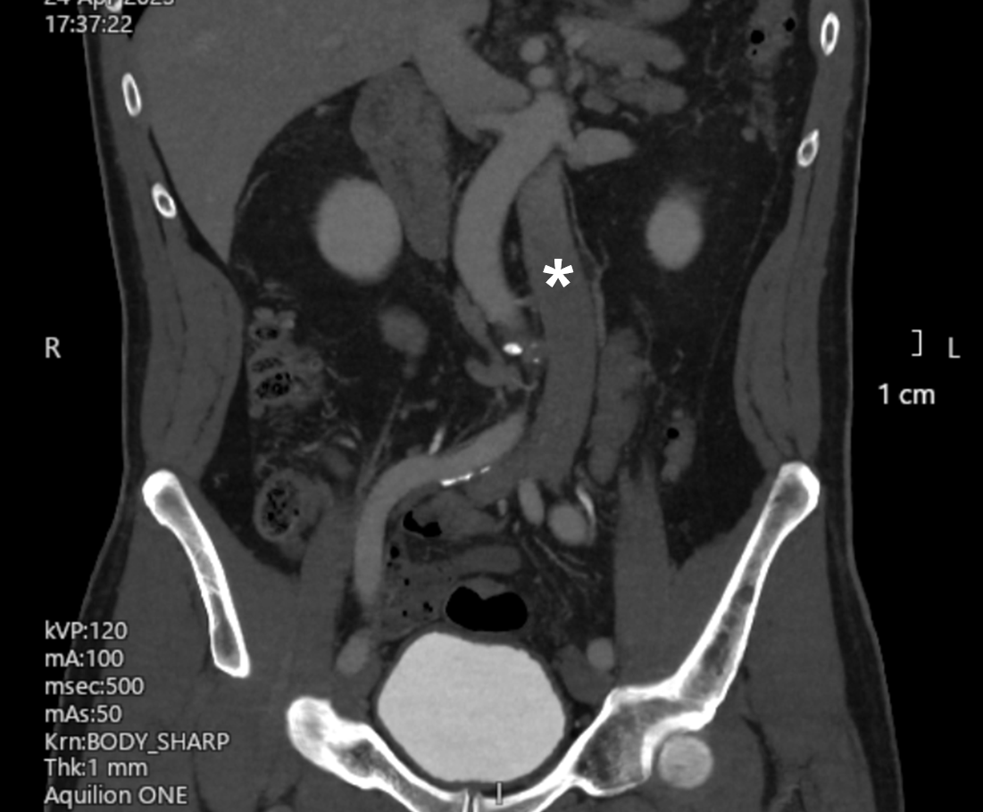 Figure 2C. coronal plane image from the patient’s computed tomography venogram.