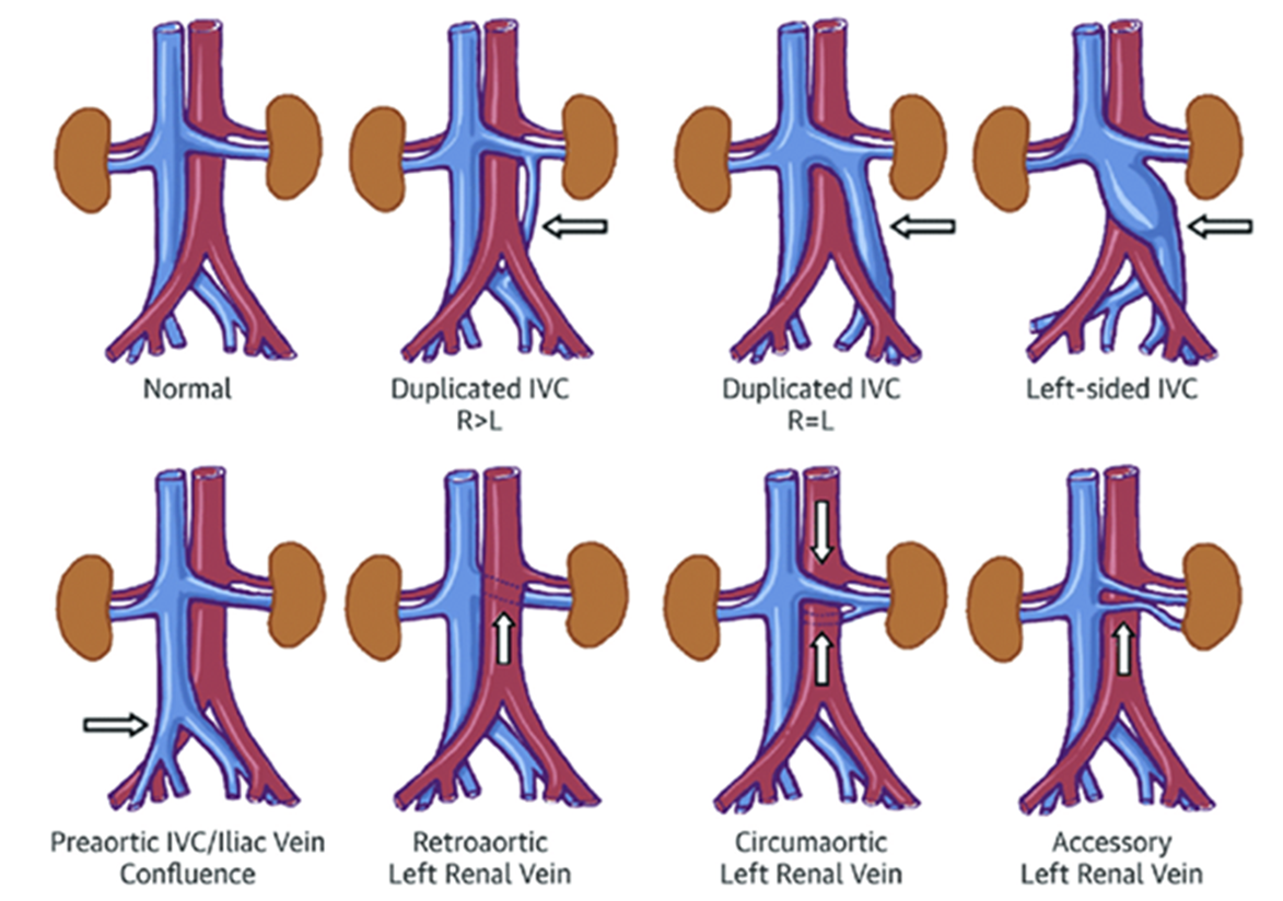 Figure 3. Congenital anomalies of inferior vena cava