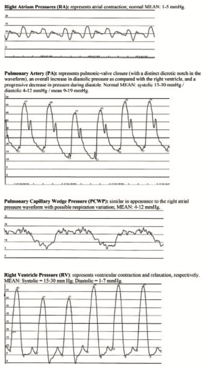 Chandler Right Heart Cath Figure 1