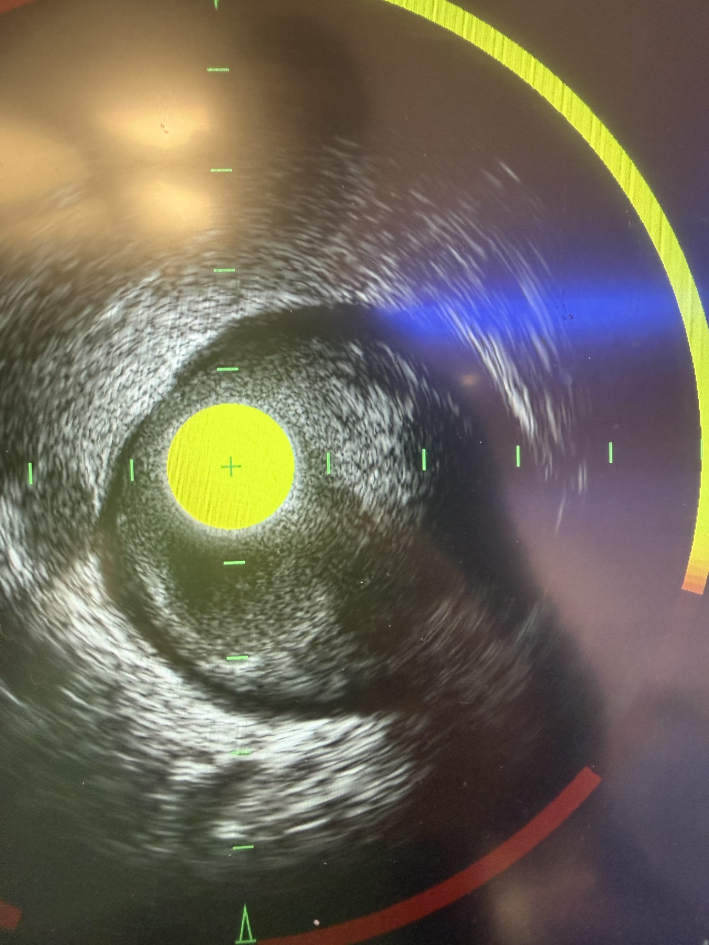 Chatterjee Figure 1. Non ST-elevation myocardial infarction with left circumflex (LCx)  plaque rupture within lipid-rich plaque for an angiographically moderate lesion.