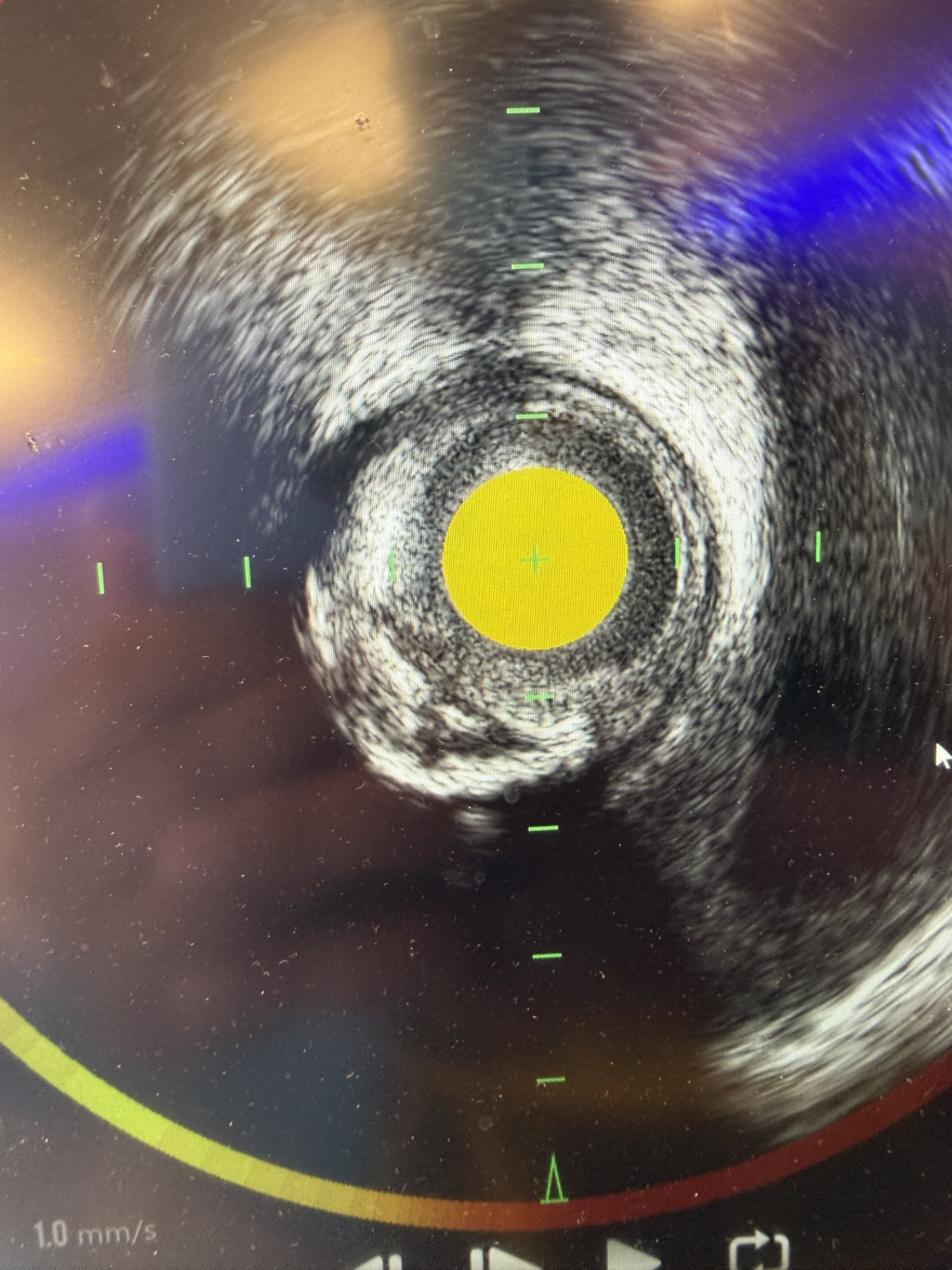 Chatterjee Figure 2. Additional image for a separate proximal LCx lesion with evidence of  plaque rupture within mixed calcific/ vulnerable plaque (as seen by yellow arc on near-infrared spectroscopy [NIRS]).