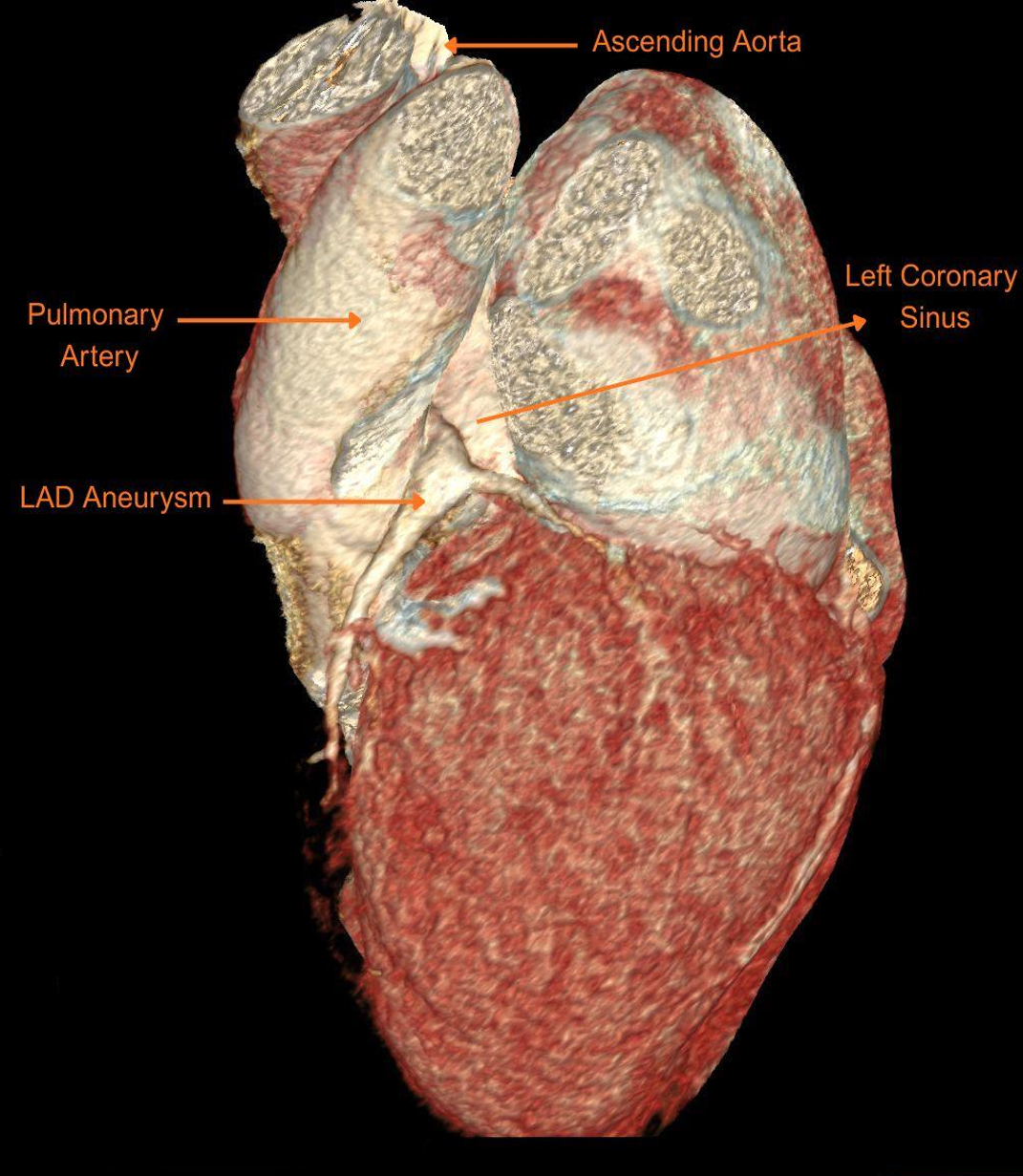 Figure 1A. Aneurysmal proximal left anterior descending artery with a maximum size of 6.6 mm. (B) Aneurysmal proximal right coronary artery with a maximum size of 8.6 mm