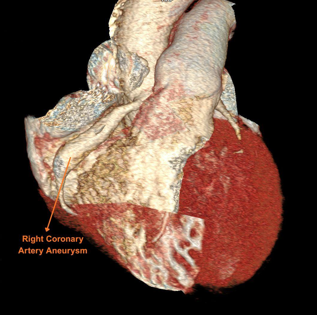 Figure 1B.Aneurysmal proximal right coronary artery