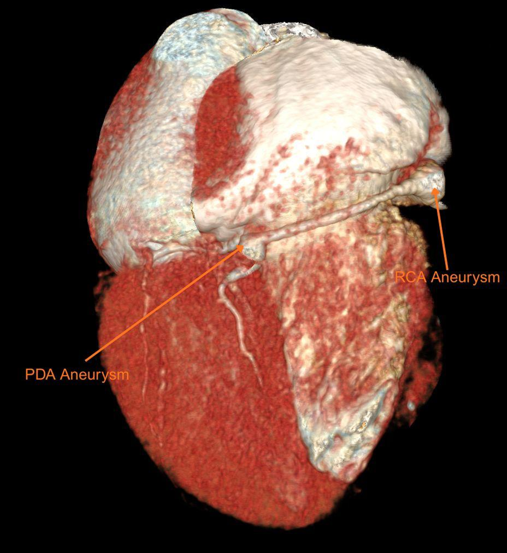 Figure 1C. Aneurysmal posterior descending artery