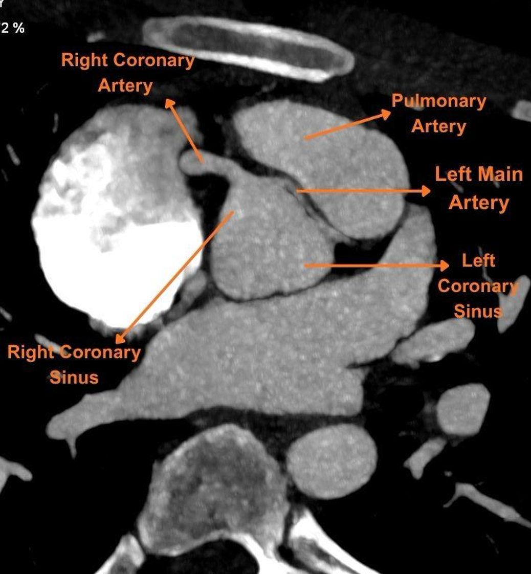 Figure 2. Computed tomography coronary angiography