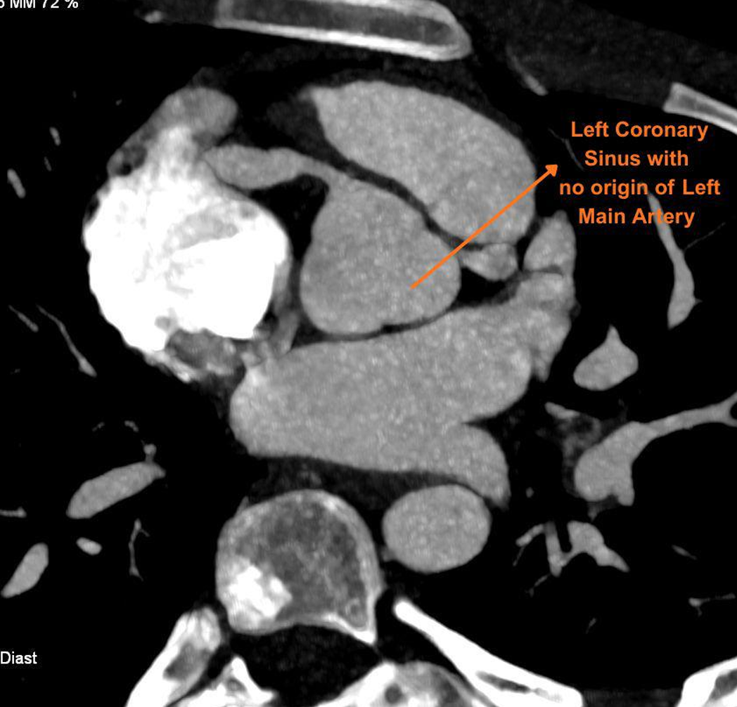 Figure 3. Computed tomography coronary angiography image showing an empty left coronary sinus