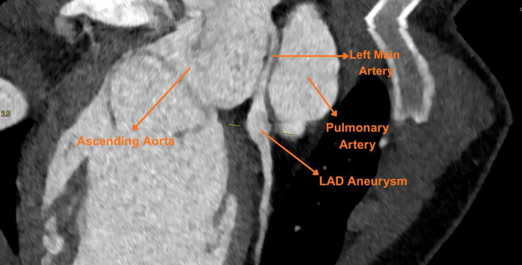 Figure 4. CCTA (sagittal section) showing the malignant interarterial course of the left main coronary artery