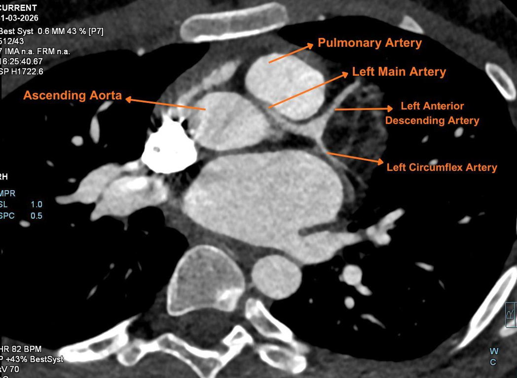 Figure 5. CCTA (transverse section) showing the malignant interarterial course of the left main coronary artery