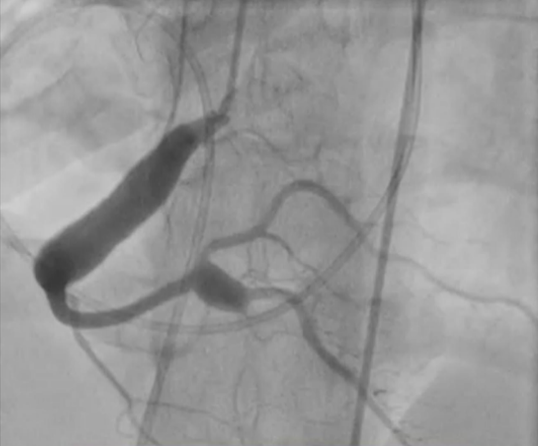 Figure 6. Right coronary injection