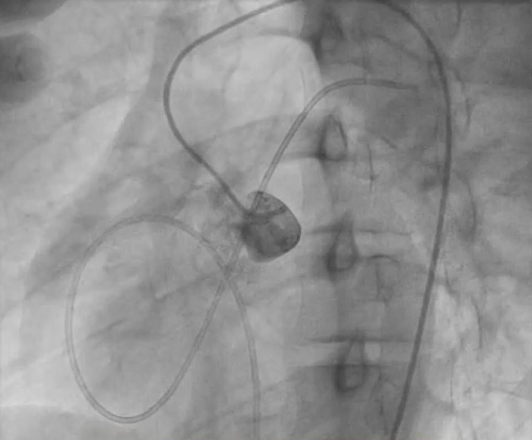 Figure 7. Left coronary sinus injection