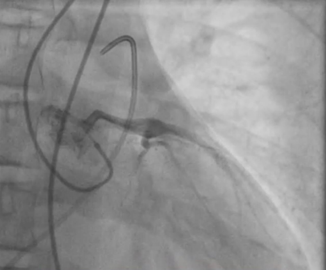 Figure 8. Left coronary injection with the internal mammary artery catheter
