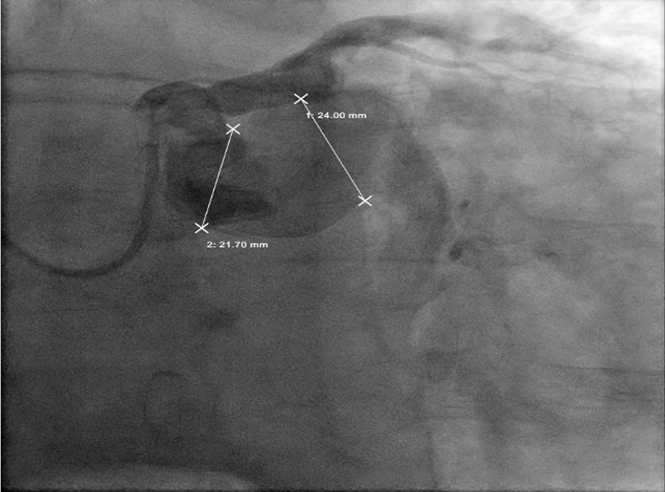Figure 1. Giant left anterior descending (LAD) aneurysm measuring 11 mm, extending from proximal to mid artery.