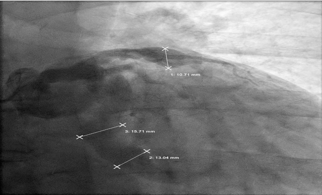 Figure 2. Giant proximal circumflex artery aneurysm measuring 24 mm, with minimal filling of distal artery.