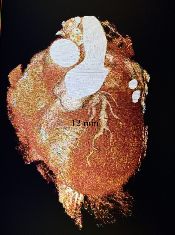 Figure 4. Cardiac CT 3D rendition showing giant LAD aneurysm measuring 12 mm.