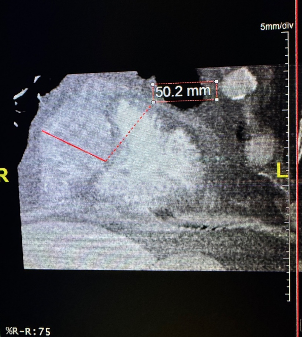 Figure 6. Cardiac CT 3D rendition showing giant RCA aneurysm measuring 50 mm.