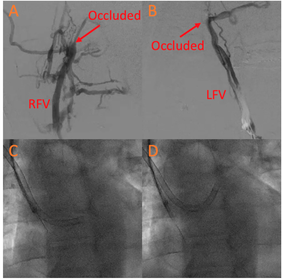 Chiang Deep Vein Thrombosis Figure 1A