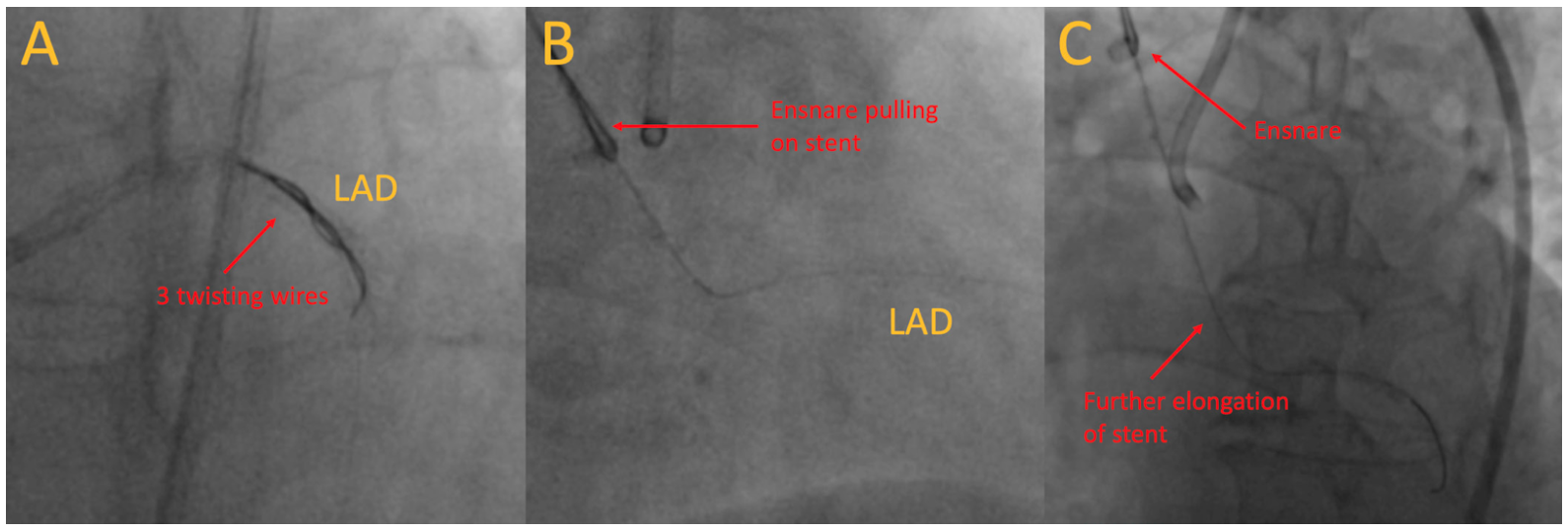 Chiang Snaring Figure 2