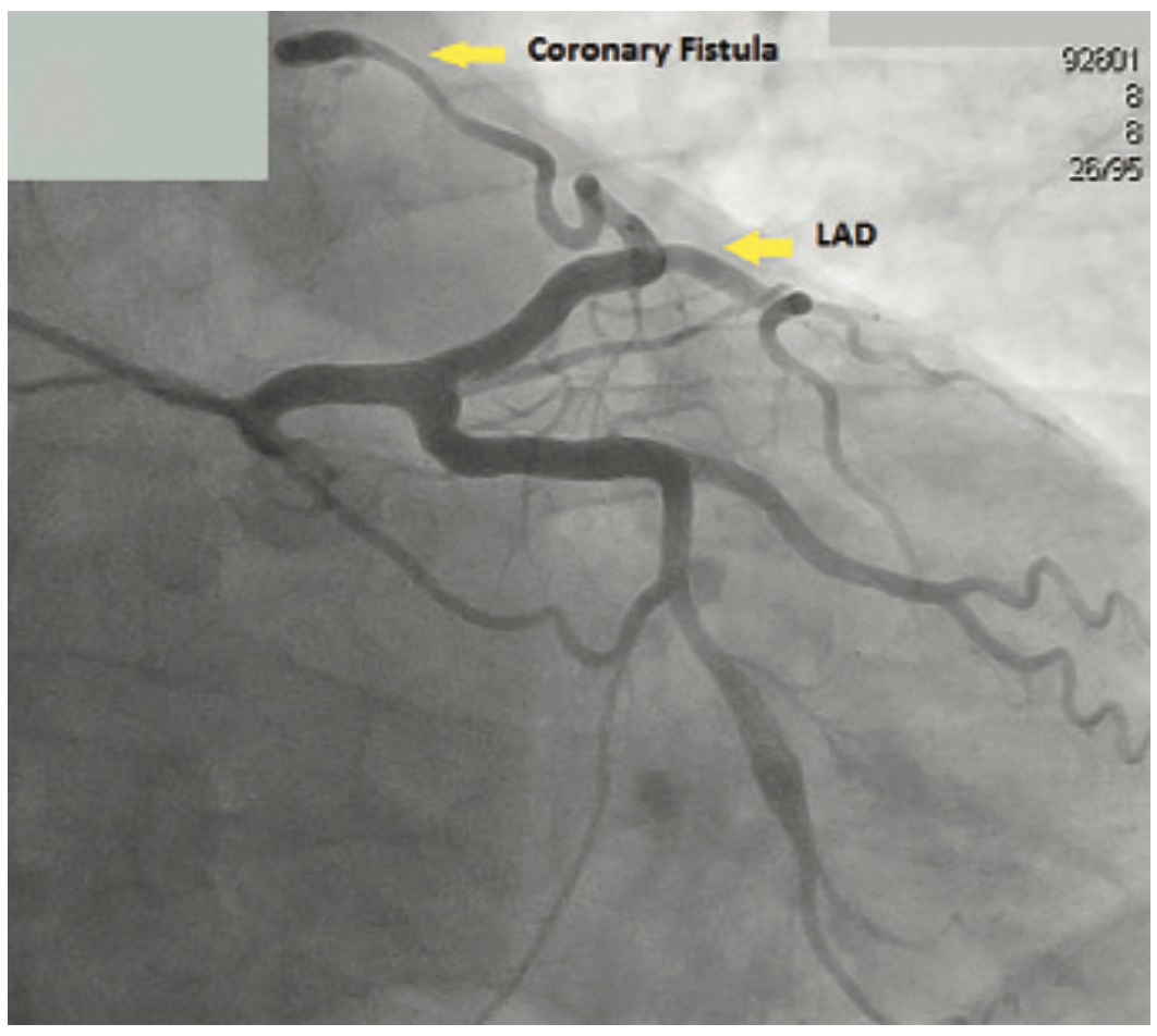 Chowdhury Atrial Fibrillation Figure 1