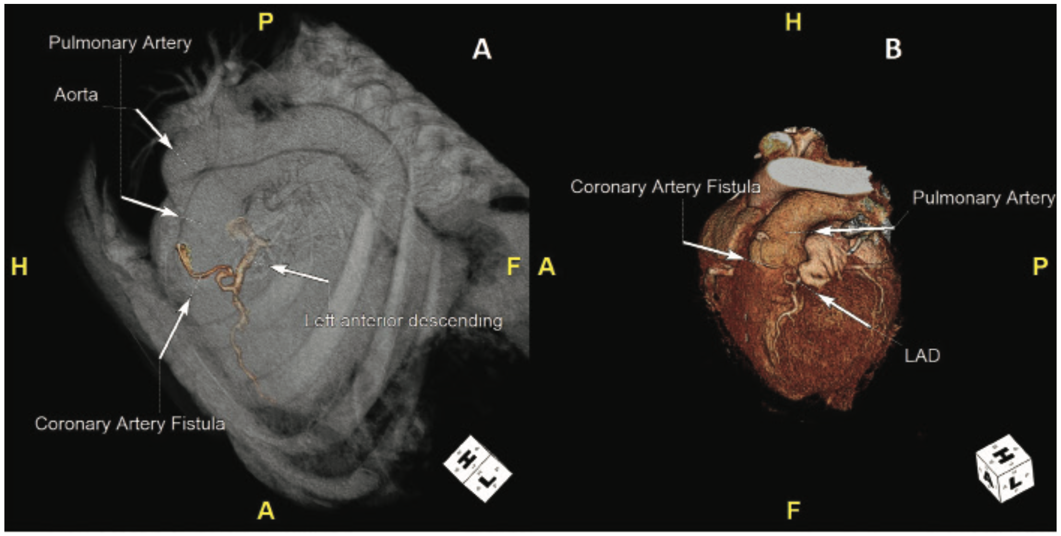 Chowdhury Atrial Fibrillation Figure 2