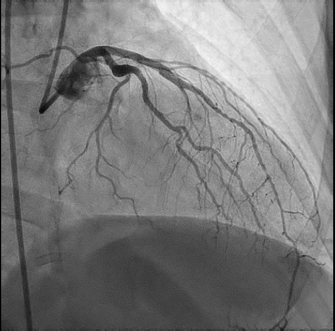 Figure 1. Coronary angiography during acute presentation demonstrated diffuse severe coronary narrowing with a beaded “string-of-pearls” appearance, concerning for acute coronary occlusion.