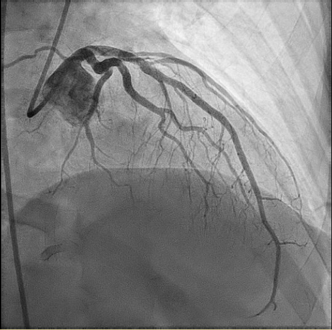 Figure 2. Coronary angiography after treatment showed improved vessel diameter and resolution of diffuse narrowing following intracoronary vasodilator administration