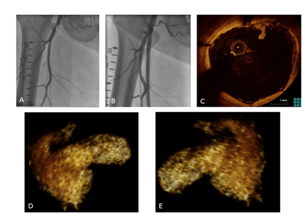 Figure 1A-E. Example of a 62-year-old male with a CTO of the SFA. (A) Peripheral angiography showing total occlusion of the superficial femoral artery (SFA). (B) Successful recanalization of the SFA occlusion following percutaneous intervention with balloon angioplasty and stent placement. (C) OCT imaging showing intraluminal clot at 1 o’clock position. (D-E). 3D reconstruction of the clot.  CTO: chronic total occlusion; SFA: superficial femoral artery; OCT: optical coherence tomography.