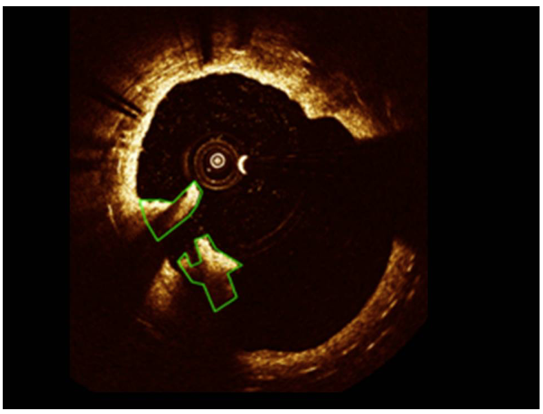 Figure 2. Example of clot quantification using OCT. Frame showing thrombi traced in green. 