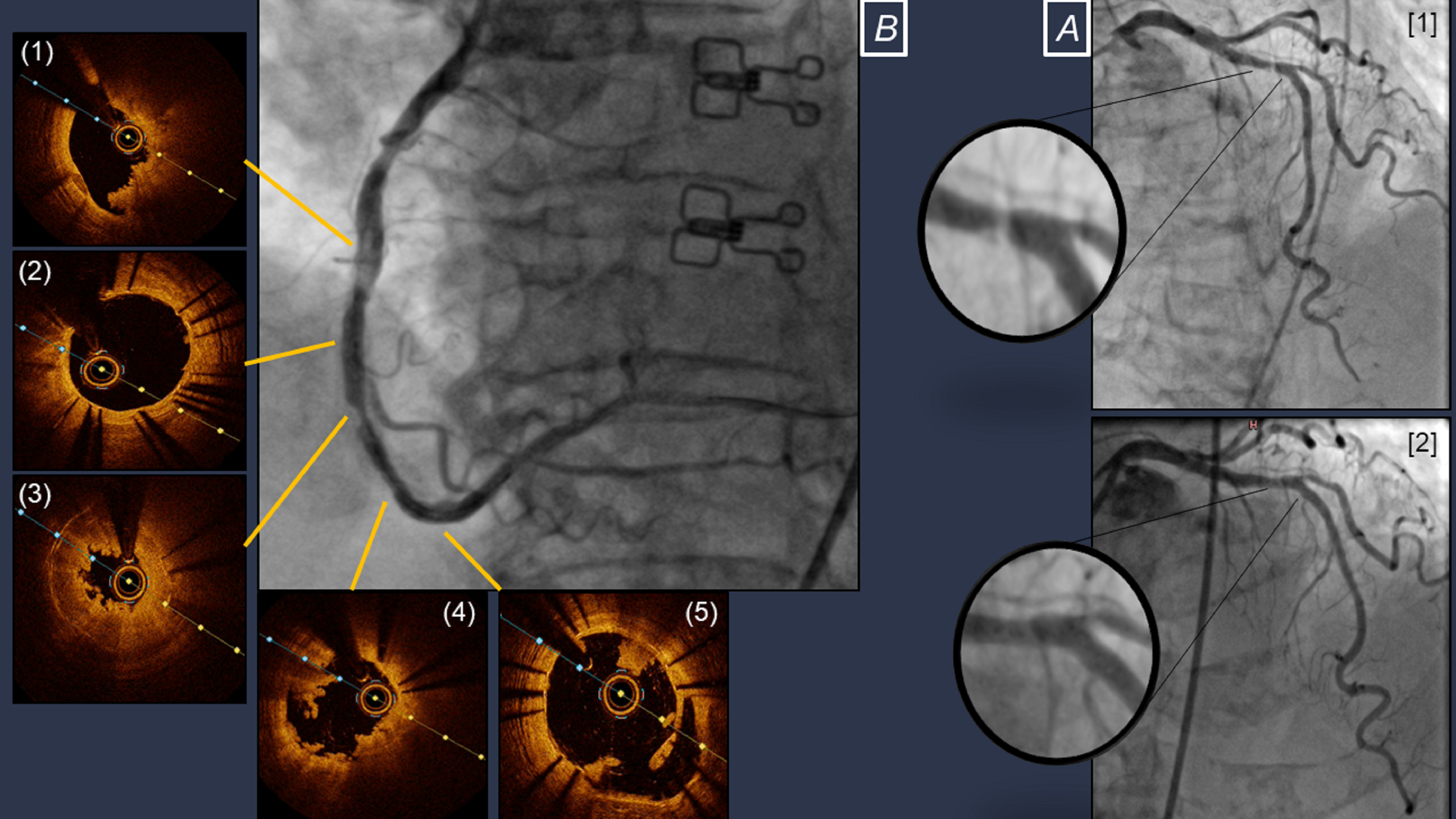 Figure. (A) Angiography of the left coronary artery