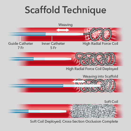 Cilingiroglu Figure 4 Scaffold Technique