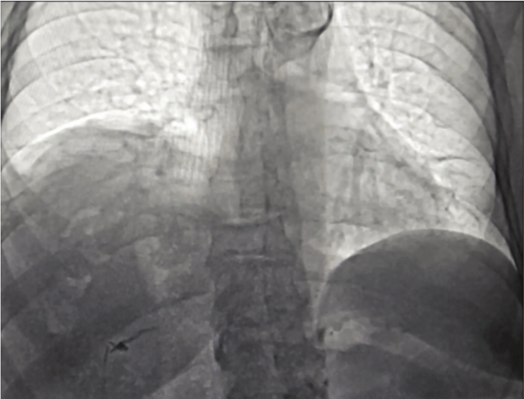 Phrenic Nerve Injury After Combined Ablation for Atrial Fibrillation and Atrial Flutter